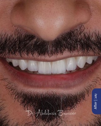 بعد - حالة علاجية - تجميل الأسنان