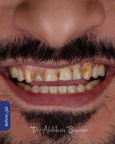 قبل - حالة علاجية - تجميل الأسنان